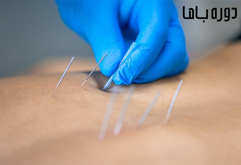 آموزش طب سوزنی