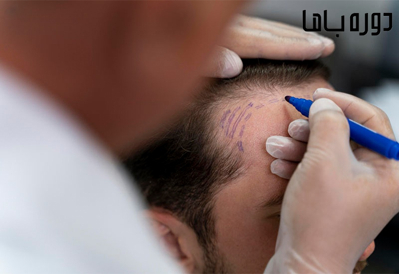 آموزش کاشت مو